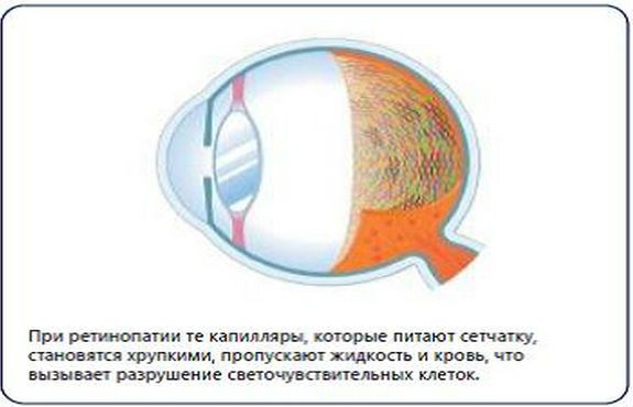 Ретинопатия
